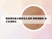 银屑病引起小腿肿怎么消肿 银屑病腿肿 自己会消肿么