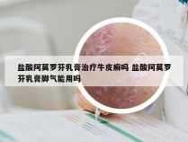 盐酸阿莫罗芬乳膏治疗牛皮癣吗 盐酸阿莫罗芬乳膏脚气能用吗