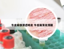 牛皮癣很薄透明皮 牛皮癣发亮薄膜