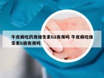 牛皮癣吃药用维生素b2有用吗 牛皮癣吃维生素b族有用吗