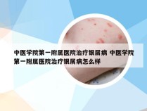 中医学院第一附属医院治疗银屑病 中医学院第一附属医院治疗银屑病怎么样