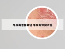 牛皮癣怎样减轻 牛皮癣如何改善