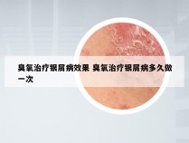 臭氧治疗银屑病效果 臭氧治疗银屑病多久做一次