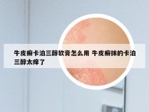 牛皮癣卡泊三醇软膏怎么用 牛皮癣抹的卡泊三醇太痒了