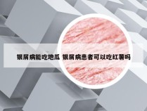 银屑病能吃地瓜 银屑病患者可以吃红薯吗