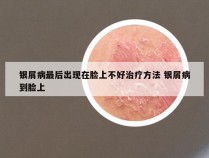 银屑病最后出现在脸上不好治疗方法 银屑病到脸上
