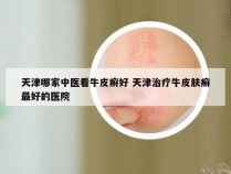 天津哪家中医看牛皮癣好 天津治疗牛皮肤癣最好的医院