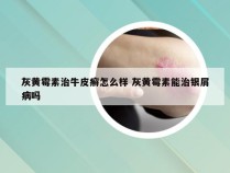灰黄霉素治牛皮癣怎么样 灰黄霉素能治银屑病吗