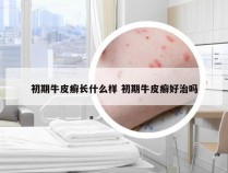 初期牛皮癣长什么样 初期牛皮癣好治吗