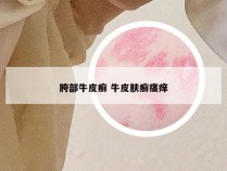 胯部牛皮癣 牛皮肤癣瘙痒