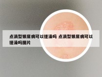 点滴型银屑病可以搓澡吗 点滴型银屑病可以搓澡吗图片