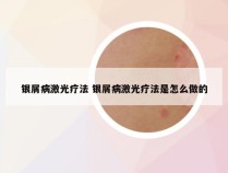 银屑病激光疗法 银屑病激光疗法是怎么做的