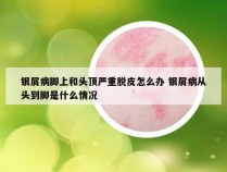 银屑病脚上和头顶严重脱皮怎么办 银屑病从头到脚是什么情况