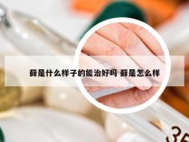 藓是什么样子的能治好吗 藓是怎么样