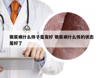 银屑病什么样子是变好 银屑病什么样的状态是好了