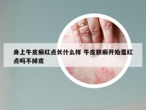 身上牛皮癣红点长什么样 牛皮肤癣开始是红点吗不掉皮