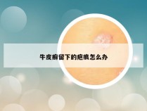 牛皮癣留下的疤痕怎么办