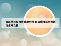 银屑病可以用黄芪泡水吗 银屑病可以用黄芪泡水吗女性