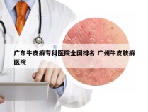 广东牛皮癣专科医院全国排名 广州牛皮肤癣医院