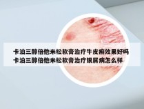 卡泊三醇倍他米松软膏治疗牛皮癣效果好吗 卡泊三醇倍他米松软膏治疗银屑病怎么样