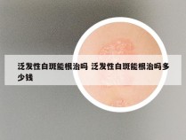 泛发性白斑能根治吗 泛发性白斑能根治吗多少钱