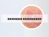 银屑病讲座直播 银屑病讲座直播视频