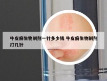 牛皮癣生物制剂一针多少钱 牛皮癣生物制剂打几针