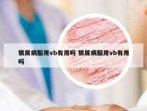 银屑病服用vb有用吗 银屑病服用vb有用吗
