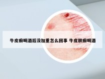牛皮癣喝酒后没加重怎么回事 牛皮肤癣喝酒