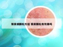 银屑病颗粒方组 银屑颗粒有效果吗
