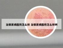 治银屑病医院怎么样 治银屑病医院怎么样啊