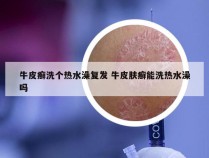 牛皮癣洗个热水澡复发 牛皮肤癣能洗热水澡吗