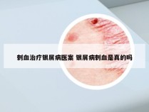 刺血治疗银屑病医案 银屑病刺血是真的吗