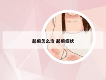 起癣怎么治 起癣症状