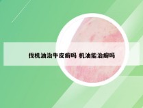 伐机油治牛皮癣吗 机油能治癣吗