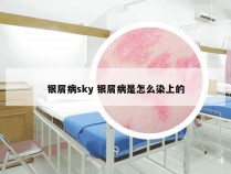 银屑病sky 银屑病是怎么染上的