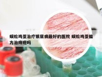 蜈蚣鸡蛋治疗银屑病最好的医院 蜈蚣鸡蛋偏方治痔疮吗