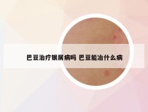 巴豆治疗银屑病吗 巴豆能冶什么病