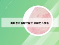 面癣怎么治疗好得快 面癣怎么根治