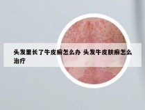 头发里长了牛皮癣怎么办 头发牛皮肤癣怎么治疗