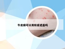 牛皮癣可以用粉底遮盖吗