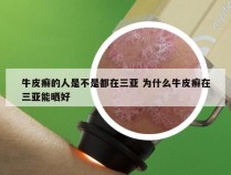 牛皮癣的人是不是都在三亚 为什么牛皮癣在三亚能晒好