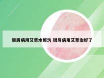 银屑病用艾草水擦洗 银屑病用艾草治好了