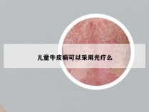 儿童牛皮癣可以采用光疗么
