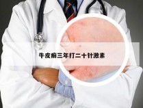 牛皮癣三年打二十针激素