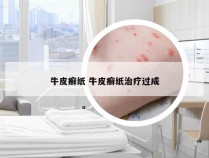 牛皮癣纸 牛皮癣纸治疗过成