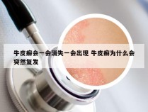 牛皮癣会一会消失一会出现 牛皮癣为什么会突然复发