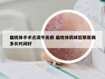 扁桃体手术点滴牛皮癣 扁桃体摘掉后银屑病多长时间好