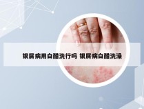 银屑病用白醋洗行吗 银屑病白醋洗澡