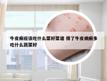 牛皮癣应该吃什么菜好菜谱 得了牛皮病癣多吃什么蔬菜好